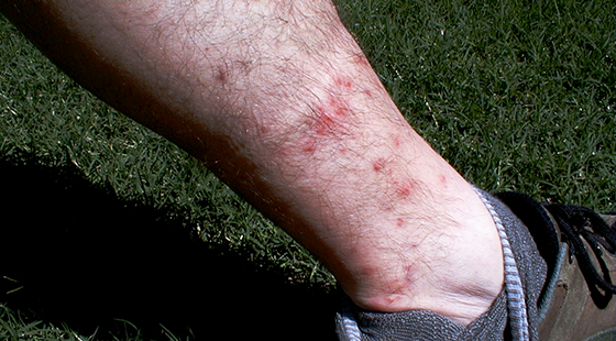 chigger bites around ankle
