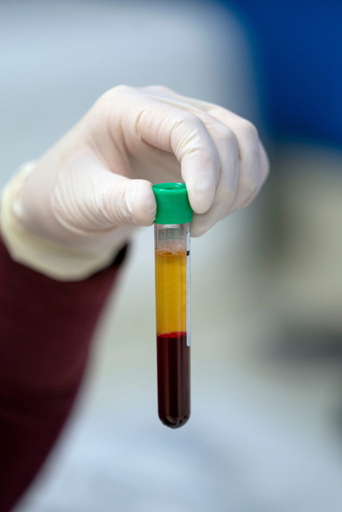 Blood collection tube that has been centrifuged, separating the yellow plasma to the top.