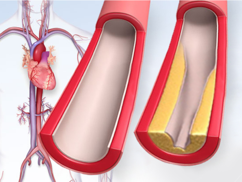 Illustration of healthy and unhealthy blood vessels due to cholesterol 
