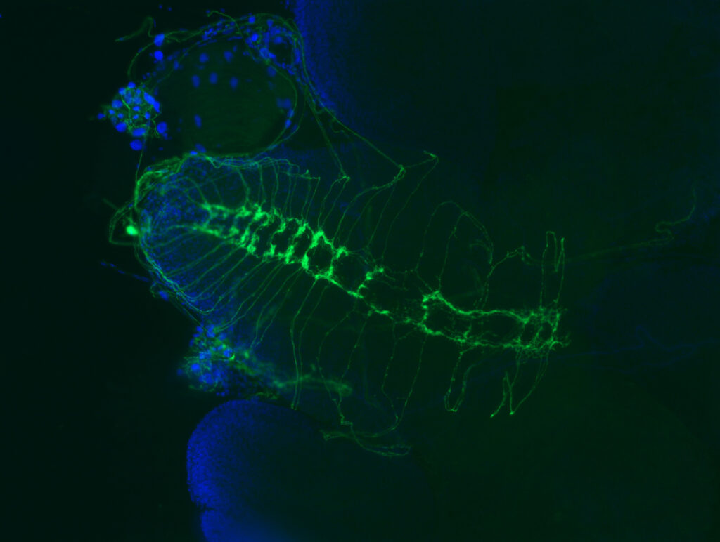 Brain of a fruit fly that has a mutation related to muscular dystrophies, showing breaks in axon wiring. 