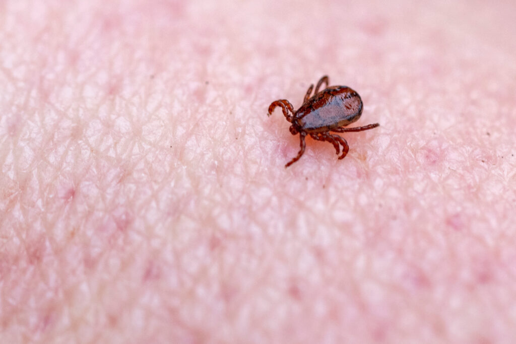 A tick on a persons skin. The entire tick is visible.